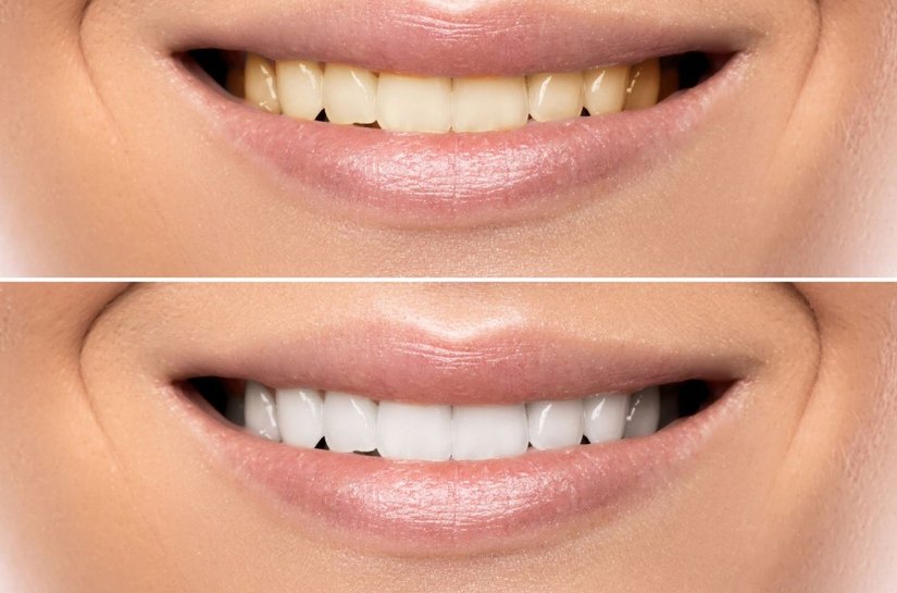 Clareamento dental caseiro sem supervisão profissional pode afetar a saúde bucal