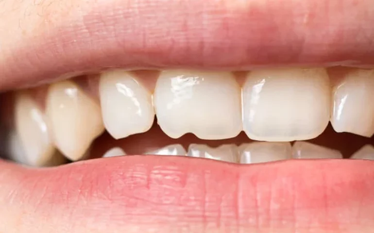 Dente quebrou ou trincou? O que fazer nos primeiros minutos para salvar o sorriso?
