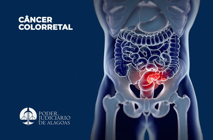 Médico do TJAL explica os sintomas e tratamento do câncer colorretal