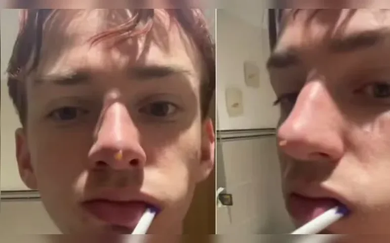 Nariz de jovem 'apodrece' após rinoplastia líquida 