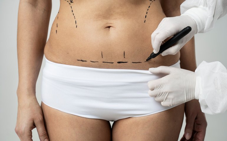 Lipoaspiração é a cirurgia estética mais realizada no mundo