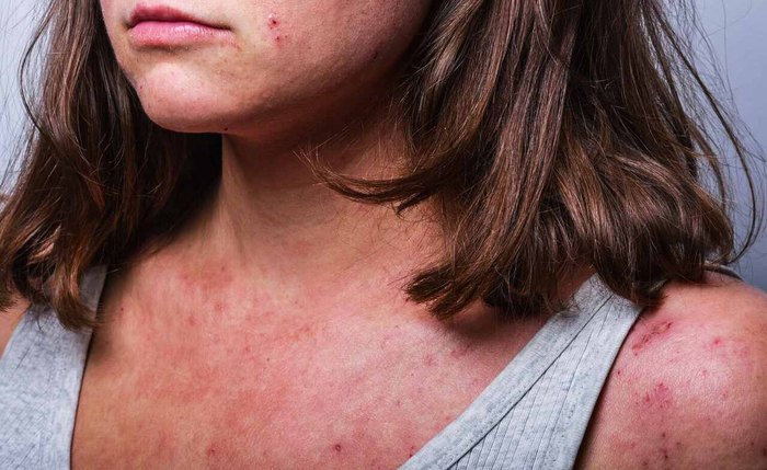 Dermatite atópica gera estigmas sociais relacionados à doença Dermatite atópica gera estigmas sociais relacionados à doença