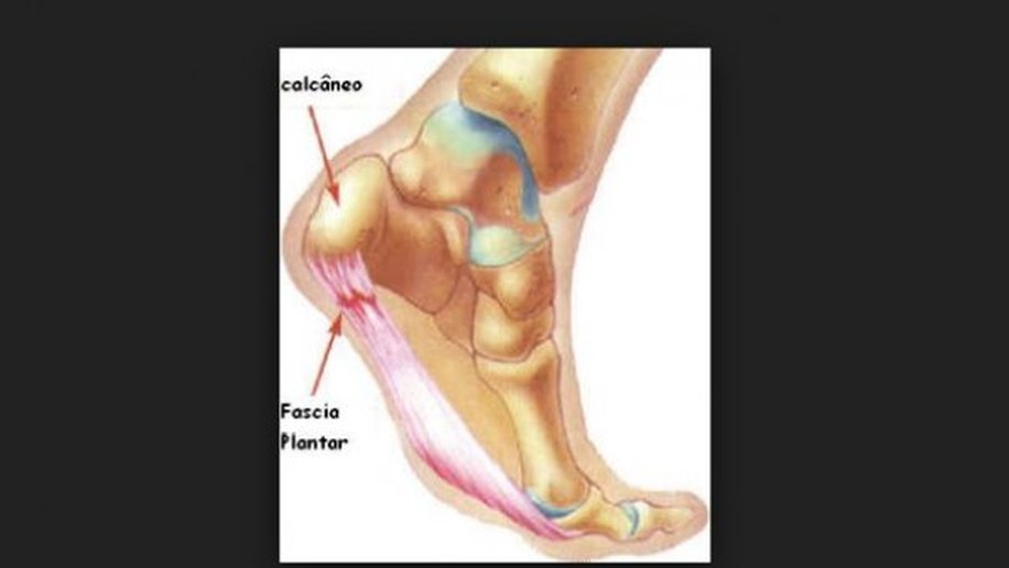 Esporão de Calcâneo e Fascite Plantar
