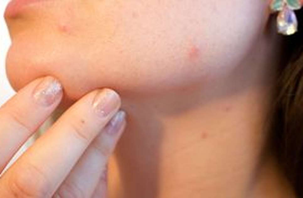 acne-1606765_1280.jpg / Foto: EBC