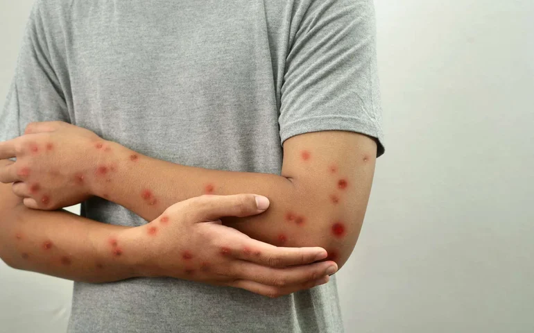 Atenção redobrada diante do aumento de casos de MPOX no Brasil
