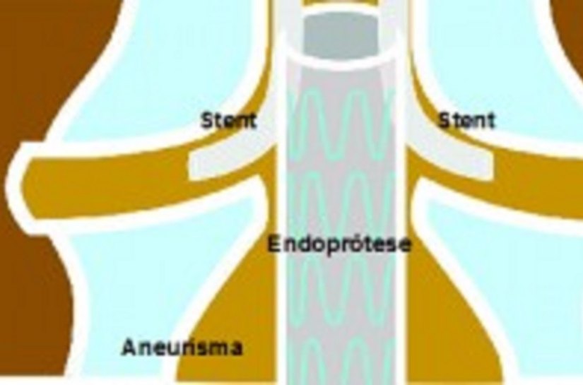 Técnica é utilizada em casos específicos