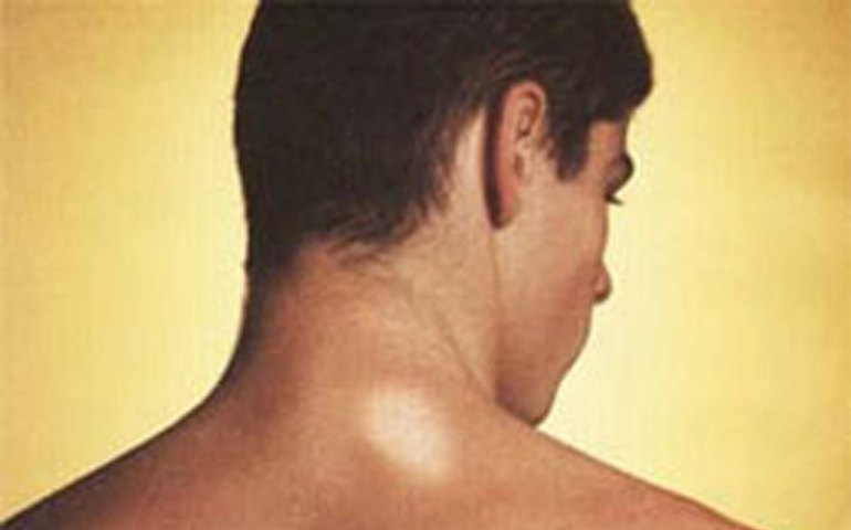 Sesau lança Campanha Mundial de Luta Contra a Hanseníase nesta quarta em Alagoas