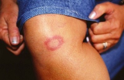 Dia Internacional do Hanseniano destaca importância do tratamento completo para erradicação da doença