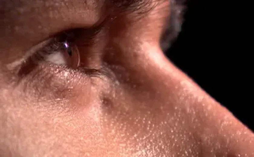 Alagoas registra aumento de casos de conjuntivite; saiba como prevenir