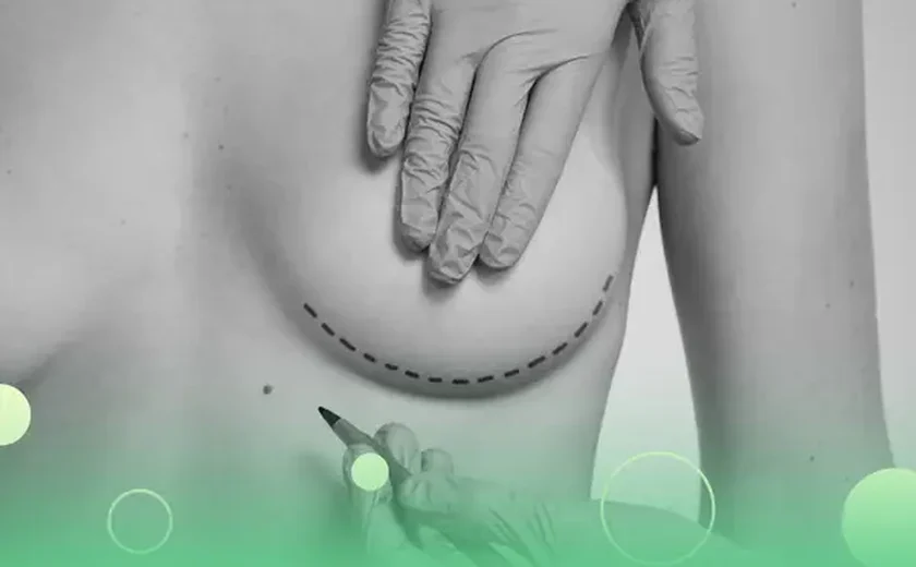 Saiba como acelerar processo de mamoplastia redutora