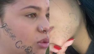 Jovem que teve rosto tatuado à força pelo companheiro mostra antes e depois após sessões de remoção / Foto: Foto: Redes Sociais/ Reprodução