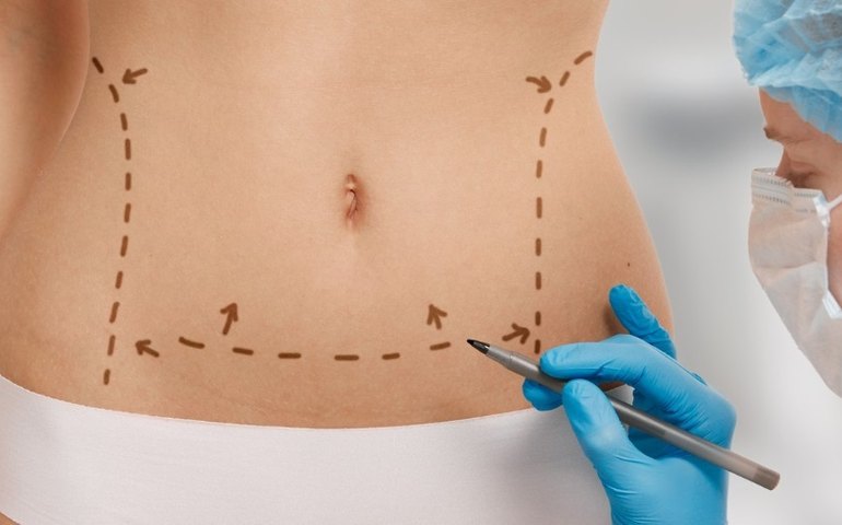 Lipoaspiração e lipoescultura apresentam diferenças entre si