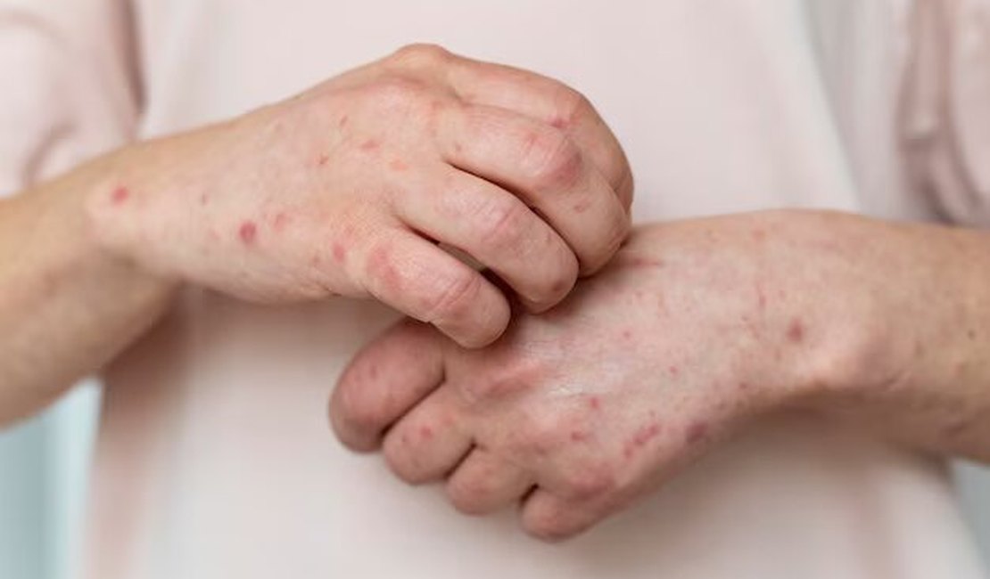 O impacto na qualidade de vida de crianças com dermatite atópica grave